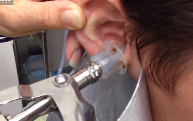 Video: Giật mình cảnh bác sĩ lấy ráy tai "siêu khủng"