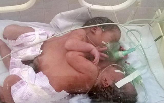 Hai bé song sinh dính liền ở Hà Giang: Khó phẫu thuật tách rời