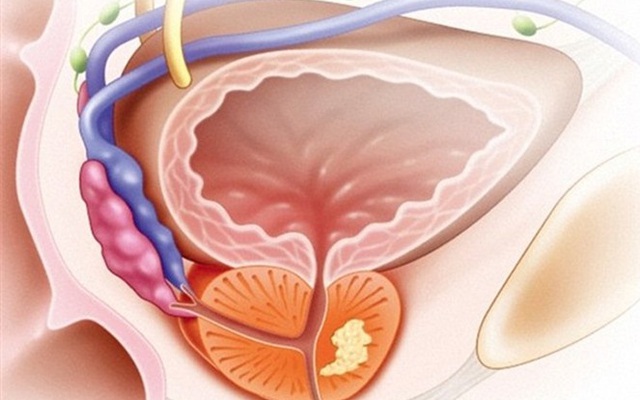Bác sĩ khuyên bạn cách ăn uống để tránh xa bệnh về tuyến tiền liệt