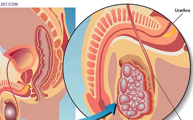 Ung thư tinh hoàn, bệnh phổ biến quý ông nhất định phải để ý