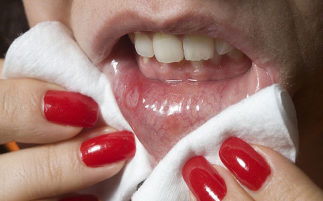 Vết lở loét ở miệng: Dấu hiệu của một số căn bệnh nguy hiểm