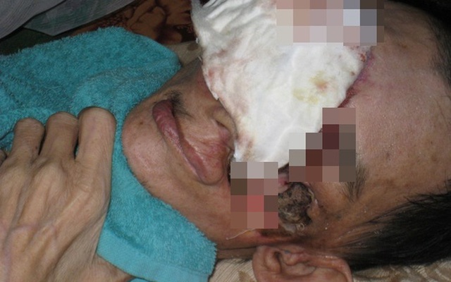 4 người đàn ông bị "ăn mòn" mặt, tai gây xôn xao ở Việt Nam