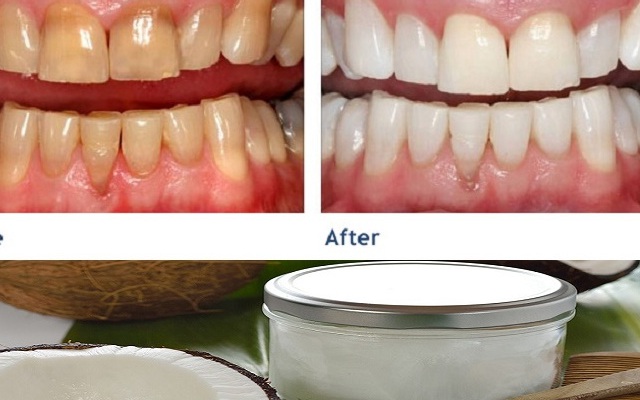 Thải độc cơ thể, ngăn ngừa bệnh răng miệng nhờ nhai dầu