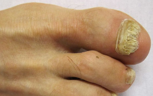 Những dấu hiệu ở móng chân, móng tay bạn nhất định phải để ý kẻo mang bệnh không biết