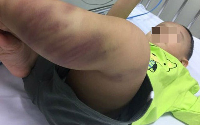 Hà Nội: Bé trai nghi bị bạo hành thâm tím khắp người được 1 phụ nữ bỏ lại bệnh viện