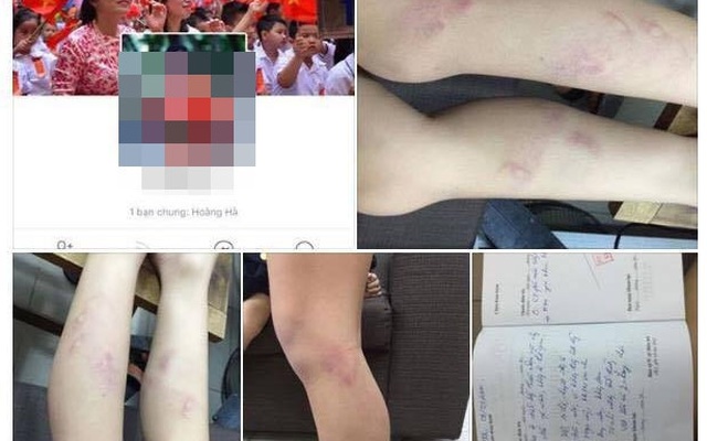 Hà Nội: Giáo viên chủ nhiệm lớp 2 bị tố đánh học sinh bầm tím chân