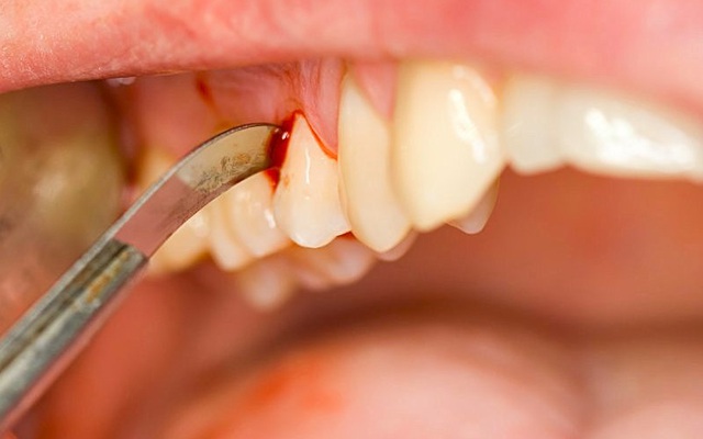 Những dấu hiệu ở răng cảnh báo nguy cơ ung thư: Thêm một lí do phải đánh răng sạch