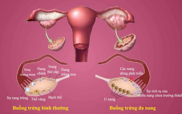 Căn bệnh dẫn đến tiểu đường, bệnh tim: Tránh xa 8 loại thực phẩm nếu bạn không muốn mắc