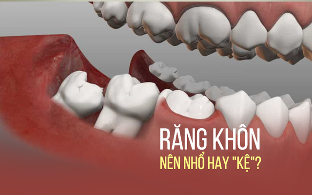 Răng khôn: Mỗi lần mọc lại một lần đau, khi nào nên nhổ?