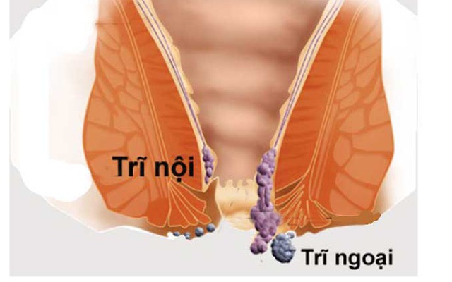 Chuyên gia "mách" bạn cách điều trị đúng bệnh trĩ