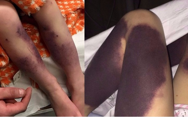 Từ vết bầm nhỏ, chân cô bé 4 tuổi đổi màu đen và suýt phải cưa bỏ vì một căn bệnh phổ biến