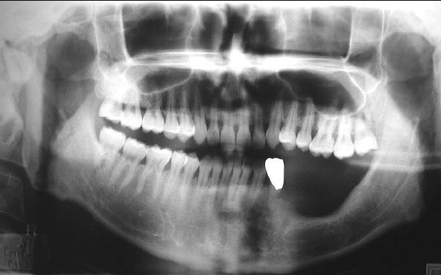 Cảnh báo: Bị đau răng chần chừ không đi khám, đến khi không chịu được thì đã hoại tử hàm