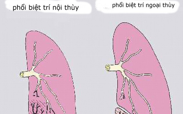 Nội soi thành công ca dị tật phổi hiếm gặp