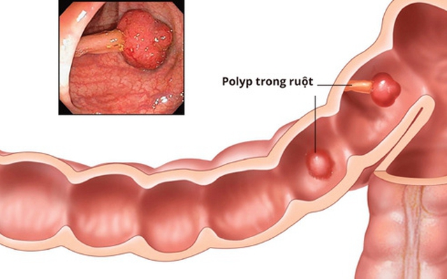 Biến chứng của bệnh polyp đại tràng