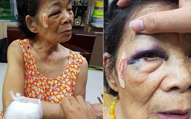 Hà Nội: Bà cụ 80 tuổi bị ô tô đâm bầm tím mắt và tay, tài xế vờ xuống xem rồi viện lý do để bỏ chạy
