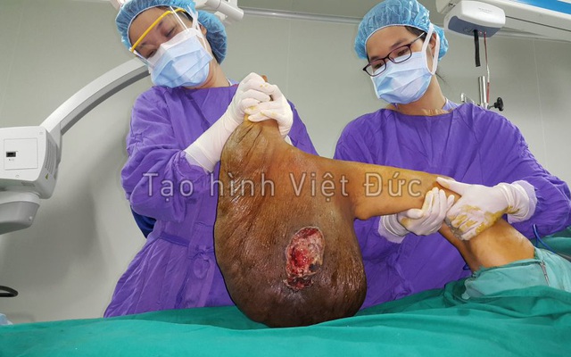 Phẫu thuật thành công khối u khổng lồ 39 năm nặng 10 kg