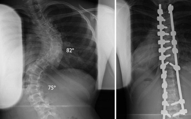 Xem quy trình phẫu thuật nắn cột sống đau nhức nhối khiến bạn chẳng bao giờ dám ngồi sai tư thế nữa