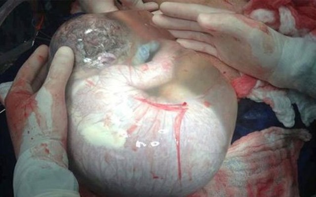 Khoảnh khắc bé sinh đôi ra khỏi bụng mẹ vẫn còn nguyên trong bọc ối