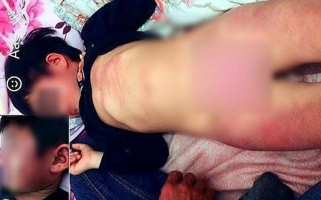 Bắc Giang: Họp báo vụ bé gái 4 tuổi nghi bị cô giáo đánh