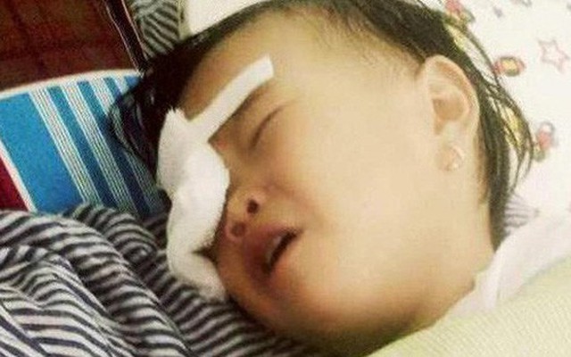 Nghệ An: Bé gái 2 tuổi bị gà chọi đá, nguy cơ hỏng mắt phải