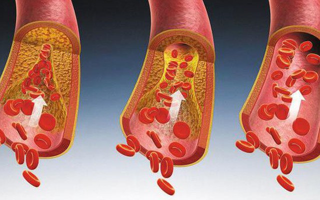 6 hành vi khiến mạch máu tắc nhanh hơn, nhiều người 'vô tư' làm hàng ngày mà không biết