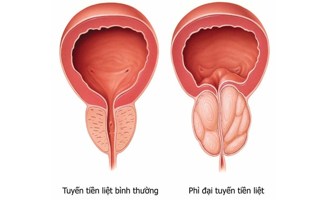 Căn bệnh nguy hiểm "lặng lẽ" tấn công 4 nhóm người, không đối phó sớm sẽ thành mãn tính