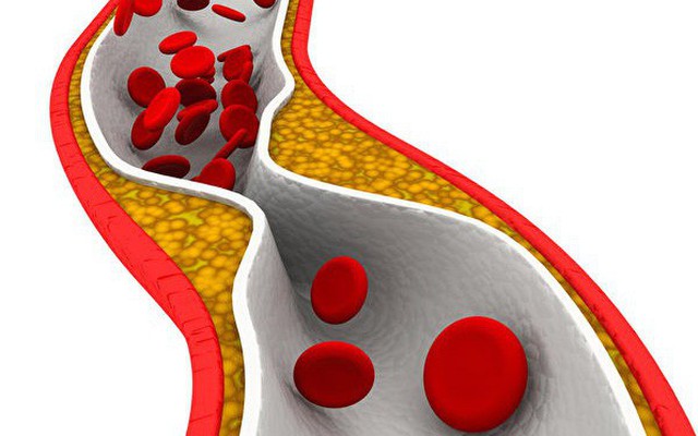 Mạch máu bị tắc có thể gây nguy hiểm tính mạng, dấu hiệu nào giúp bạn nhận biết sớm?