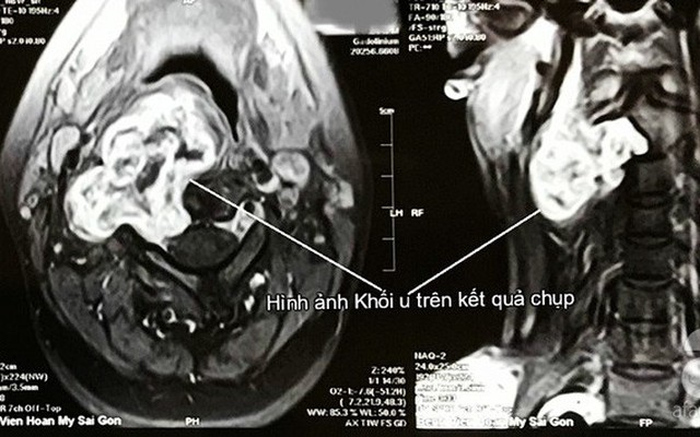 TP.HCM: Cô gái 26 tuổi suýt mất giọng nói vĩnh viễn vì mang khối u đặc biệt nhưng lầm là hạch ở cổ