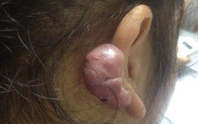 BS cảnh báo sai lầm khi bấm lỗ tai: Đừng để tai biến dạng như quả chanh