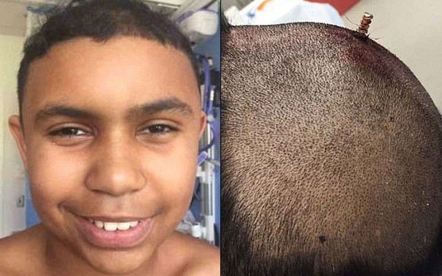 Cậu bé 13 tuổi bị chiếc đinh dài 15cm đâm xuyên sọ