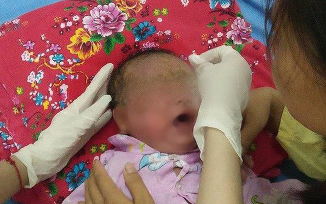 Quảng Ninh: Bé trai 32 ngày tuổi bị viêm loét toàn thân vì tắm lá