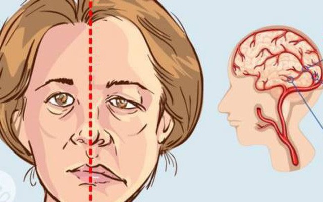 Phục hồi chức năng sau tai biến mạch máu não: Gian truân và cần sự kiên nhẫn từ cả người mắc lẫn gia đình