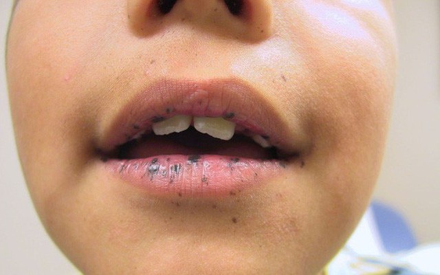 Thấy trẻ đau bụng, có vết đen lạ trên môi: Cha mẹ coi chừng con mắc hội chứng nguy hiểm, dễ dẫn đến ung thư