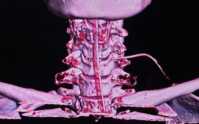 Vừa ăn vừa nói chuyện, cụ bà bị xương cá đâm xuyên từ thực quản ra cổ