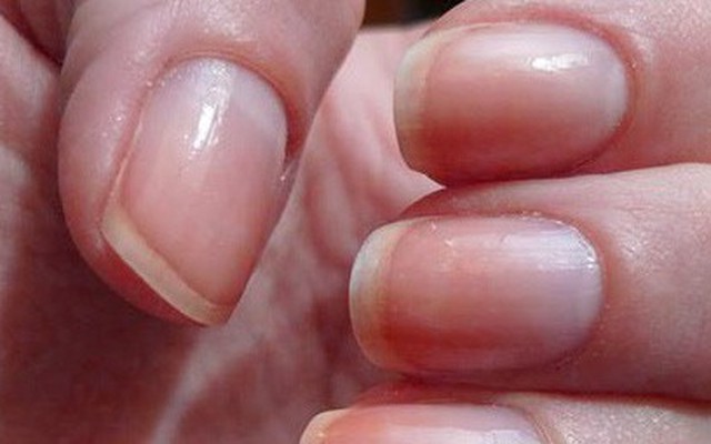 Viêm móng điều trị có khó?