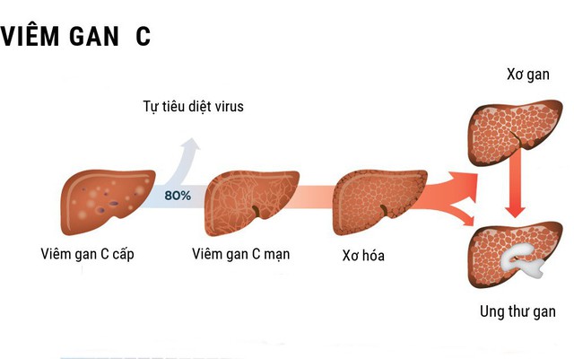 Nhiều người bị viêm gan C cấp tính nhưng không biết mình có bệnh: Những dấu hiệu cần lưu ý