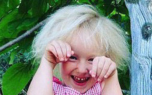 Cô bé 6 tuổi mắc hội chứng hiếm gặp khiến mái tóc dựng đứng bất thường