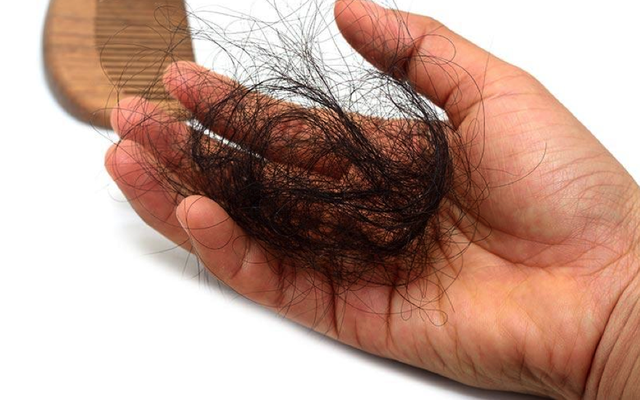 Ngày càng nhiều người trẻ bị rụng tóc: Hãy biết nguyên nhân để điều trị trước khi hói đầu