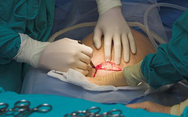 Bị đau bụng sau khi sinh mãi không khỏi, bà mẹ đi khám hốt hoảng nhận ra bác sĩ để quên thứ này trong bụng