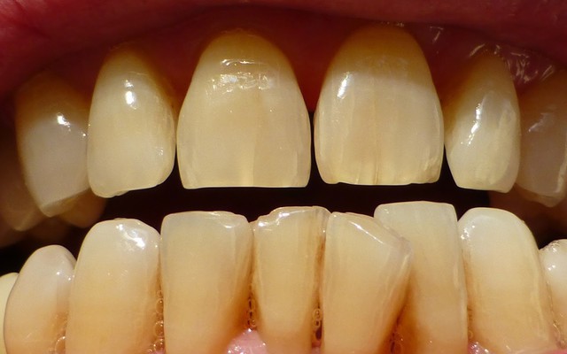Vạch mặt 6 "thủ phạm" khiến răng bạn ố vàng
