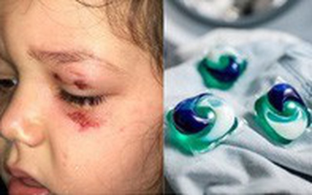 Người mẹ lên tiếng cảnh báo sau khi viên nước giặt phát nổ khiến con gái 4 tuổi bị bỏng và chấn thương vùng mắt