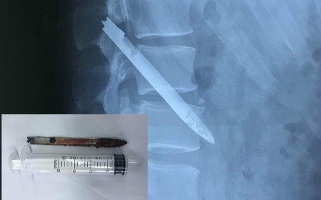 Lưỡi dao bị bỏ quên trong lưng chiến sỹ công an suốt 11 năm