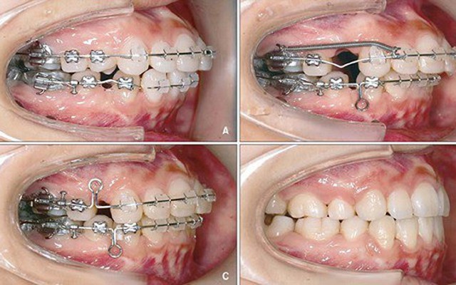 Chân răng lệch ra ngoài ổ xương vì niềng răng