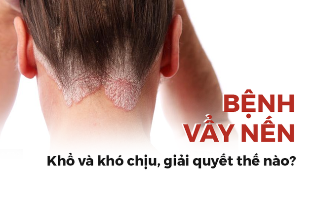 Bệnh vẩy nến có phải là vô phương cứu chữa: Hãy làm theo lời khuyên của chuyên gia da liễu