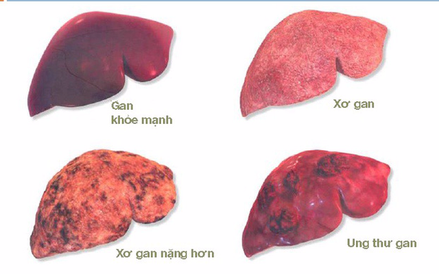 Ung thư gan: 17 nghìn người chết mỗi năm và 6 nguyên nhân cần nhớ