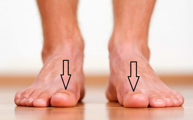 Bàn chân có 5 dấu hiệu này thì đừng chủ quan mà nên đi khám ngay