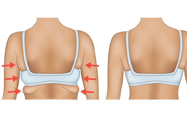 10 động tác giúp loại bỏ mỡ thừa vùng lưng và nách hiệu quả: Chị em nên tập để tự tin hơn