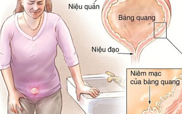 7 dấu hiệu cảnh báo bạn cần phải đi khám bàng quang trước khi quá muộn