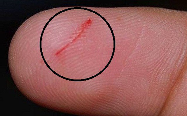 Vết trầy xước, đứt tay rất lâu lành, có phải do da "dữ": Vấn đề nghiêm trọng hơn bạn nghĩ