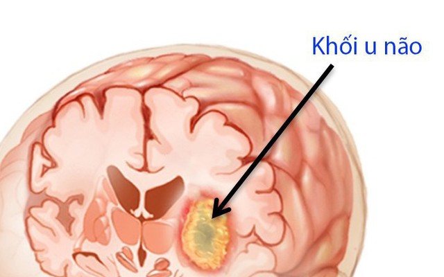 U não là nguyên nhân gây tử vong rất cao: Chuyên gia chỉ những dấu hiệu "vàng" cần đi khám